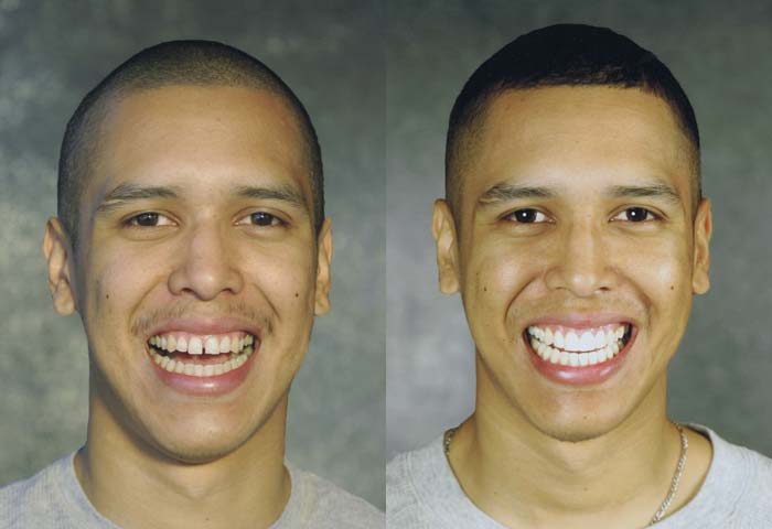 Before and After