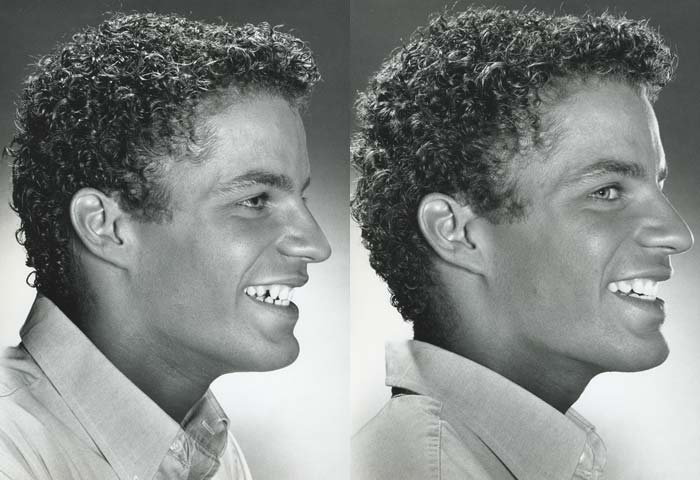 Before and After