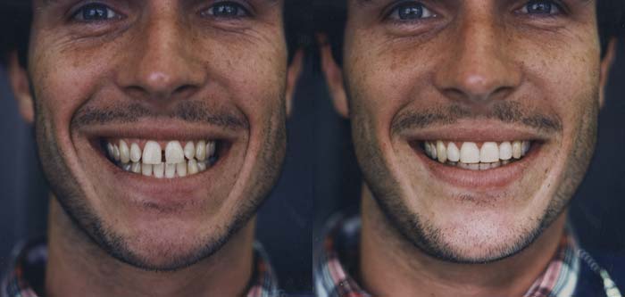 Before and After