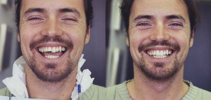 Before and After