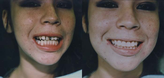 Before and After